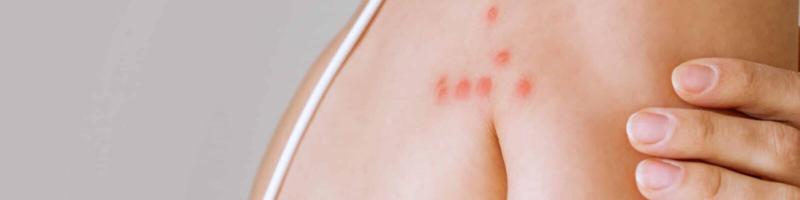 A woman with her shoulder bitten by a bedbug on a white background, close-up. Skin health problem. Red pimples Bed bug bite marks on a person's skin