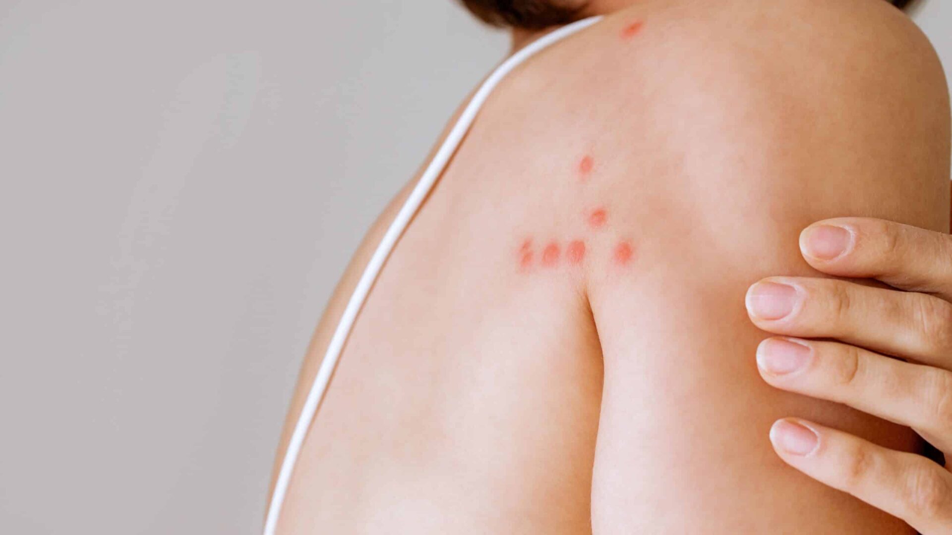 Bed bug bite marks on a person's skin