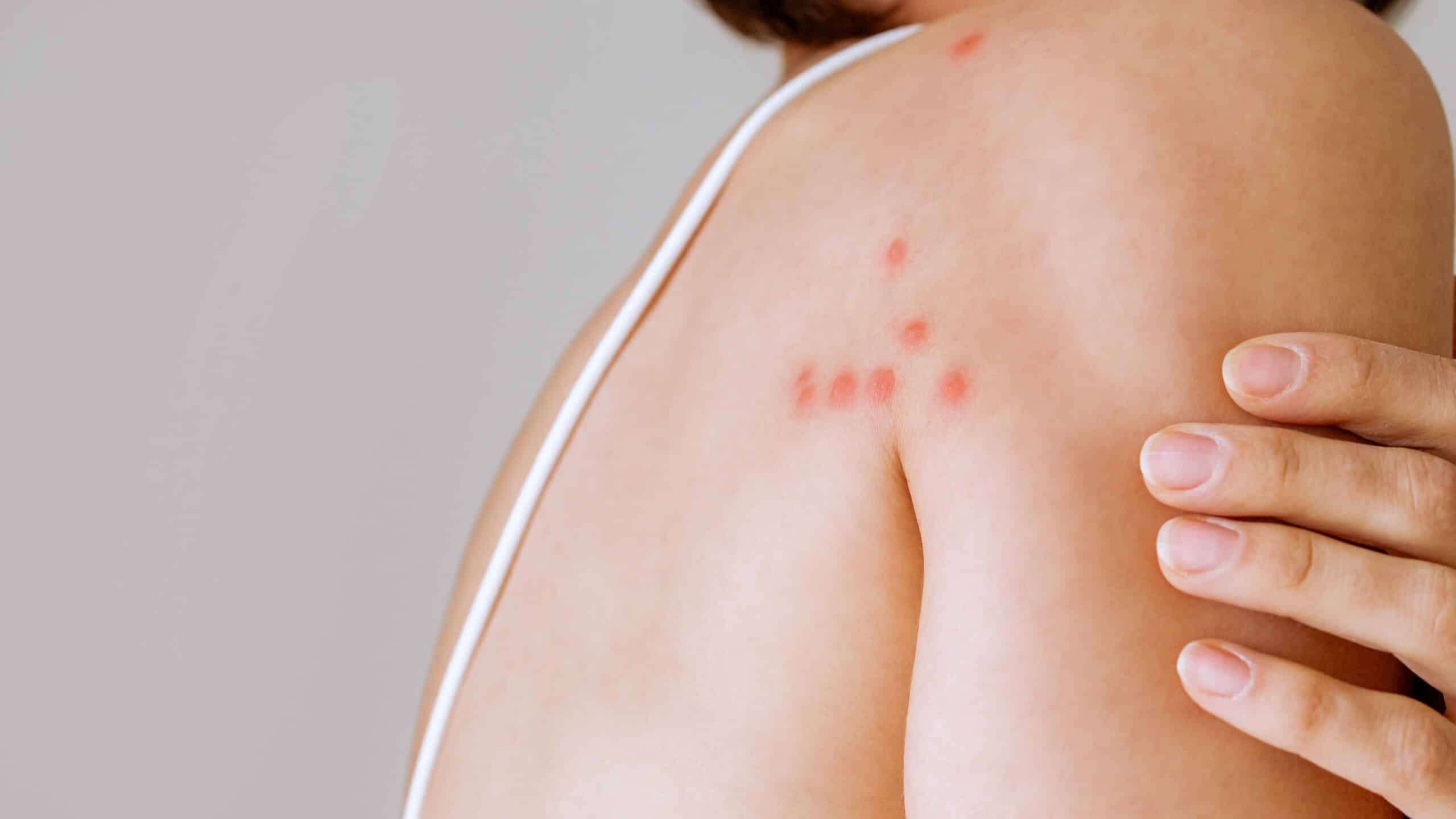 Bed bug bite marks on a person's skin